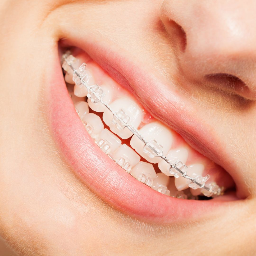 hà nội niềng răng ở đâu yenle dental